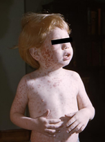 boy with rash