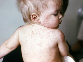 measles-symptoms.jpg