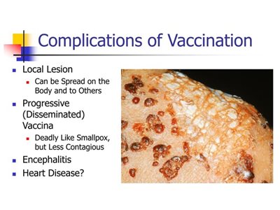 smallpox vaccine complications